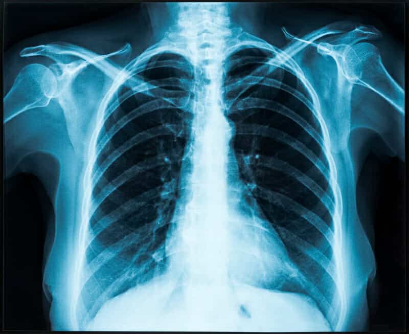 Un’intelligenza artificiale per stimare l’età cronologica attraverso radiografie del torace