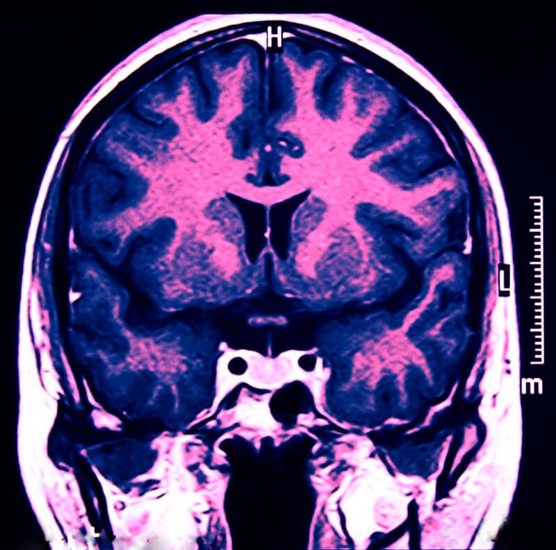 Visualizzazione avanzata dei nervi con l’Imaging Fotoacustico