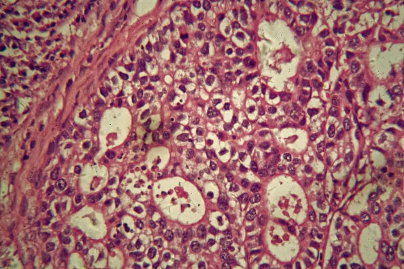 Scienziati sviluppano nuova terapia contro il cancro che blocca la crescita tumorale