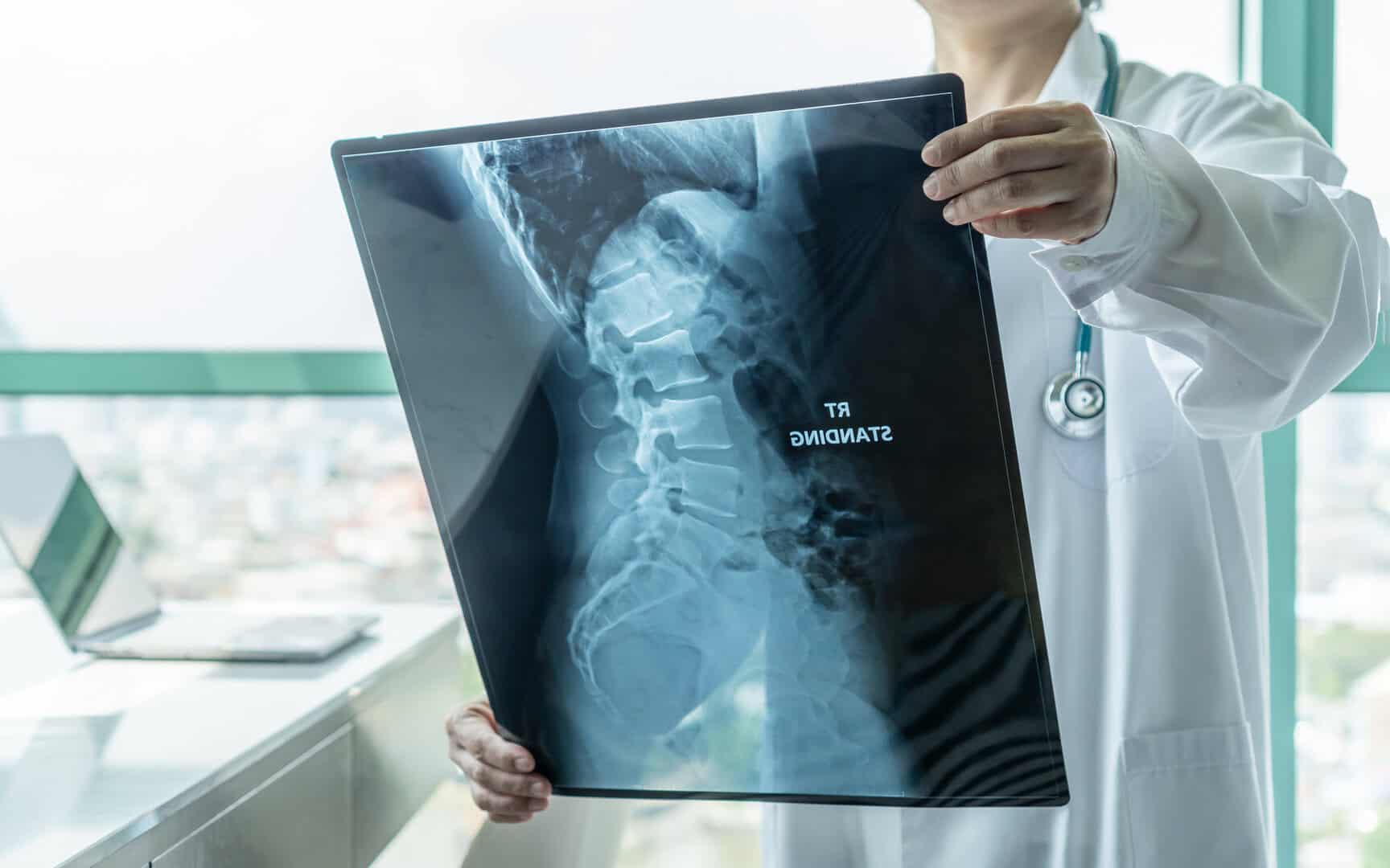 Scoperta sul cancro alle ossa: la nuova terapia con t-cell di UCL mostra promesse