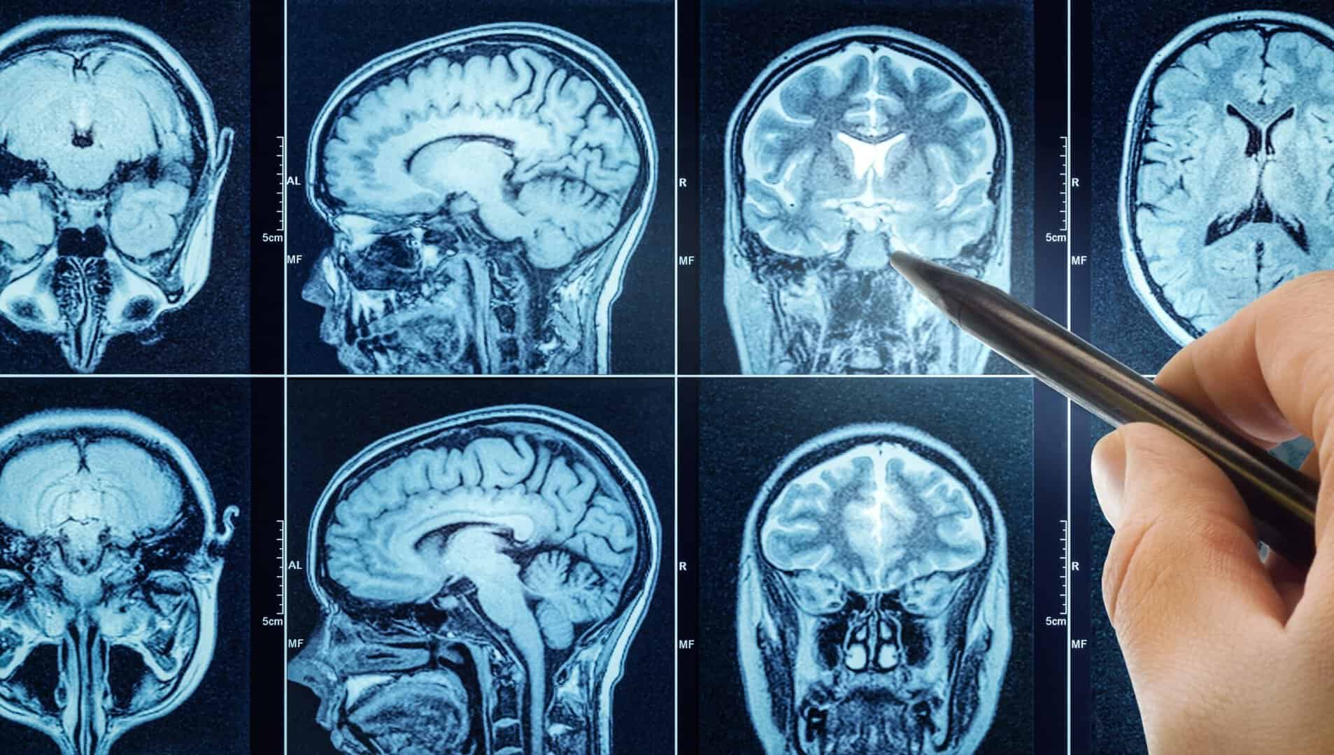 Scoperta nel cancro al cervello: nuova terapia distrugge il glioblastoma con un percorso innovativo